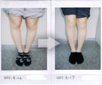 Ｏ脚の改善例写真12
