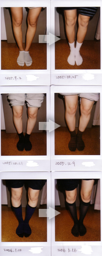 Ｏ脚の改善例写真5